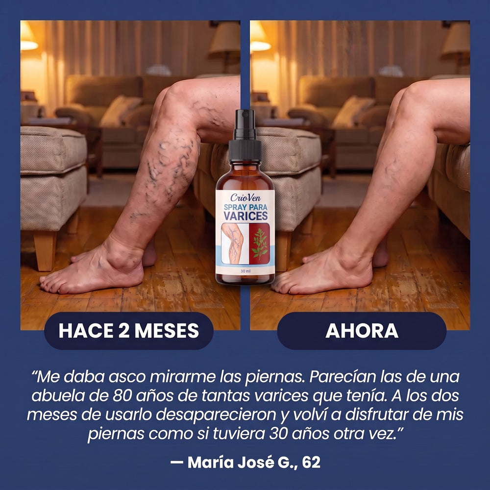 Antes y después: piernas con varices hace 2 meses y ahora con el spray CrioVen