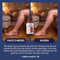 Antes y después: piernas con varices hace 2 meses y ahora con el spray CrioVen