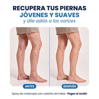 Antes y después: piernas jóvenes y suaves sin varices