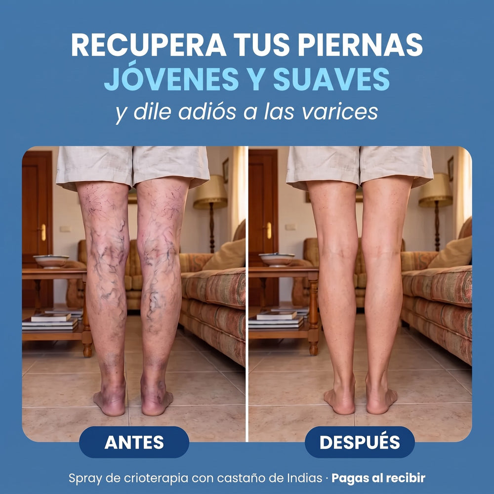 Antes y después de las varices en las piernas