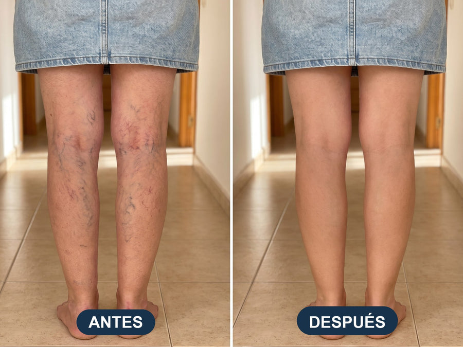 Observa cómo tus piernas pasan de “cansadas y llenas de venitas” a